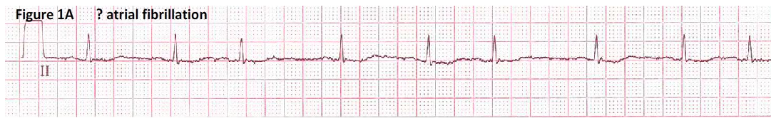 Atrial fib ecg