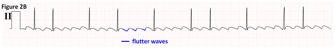 atrial fibrillation rhythm strip