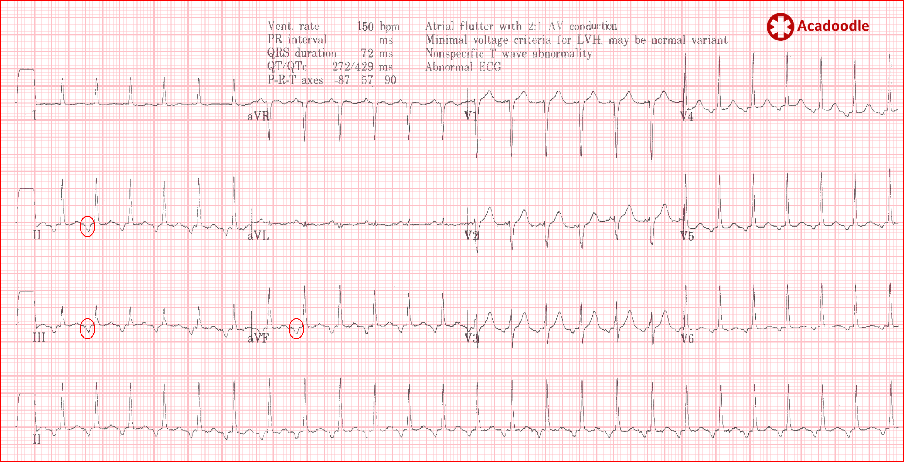 does a flutter have p waves