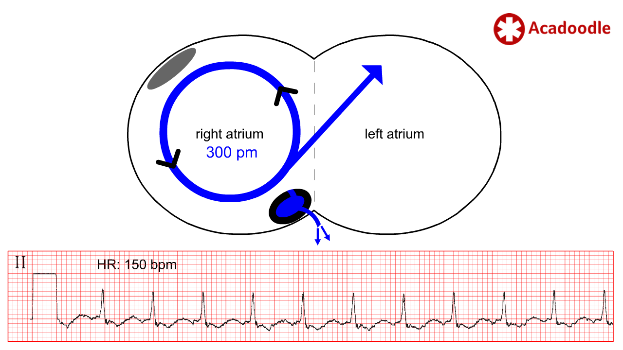 ventricular flutter vs fibrillation