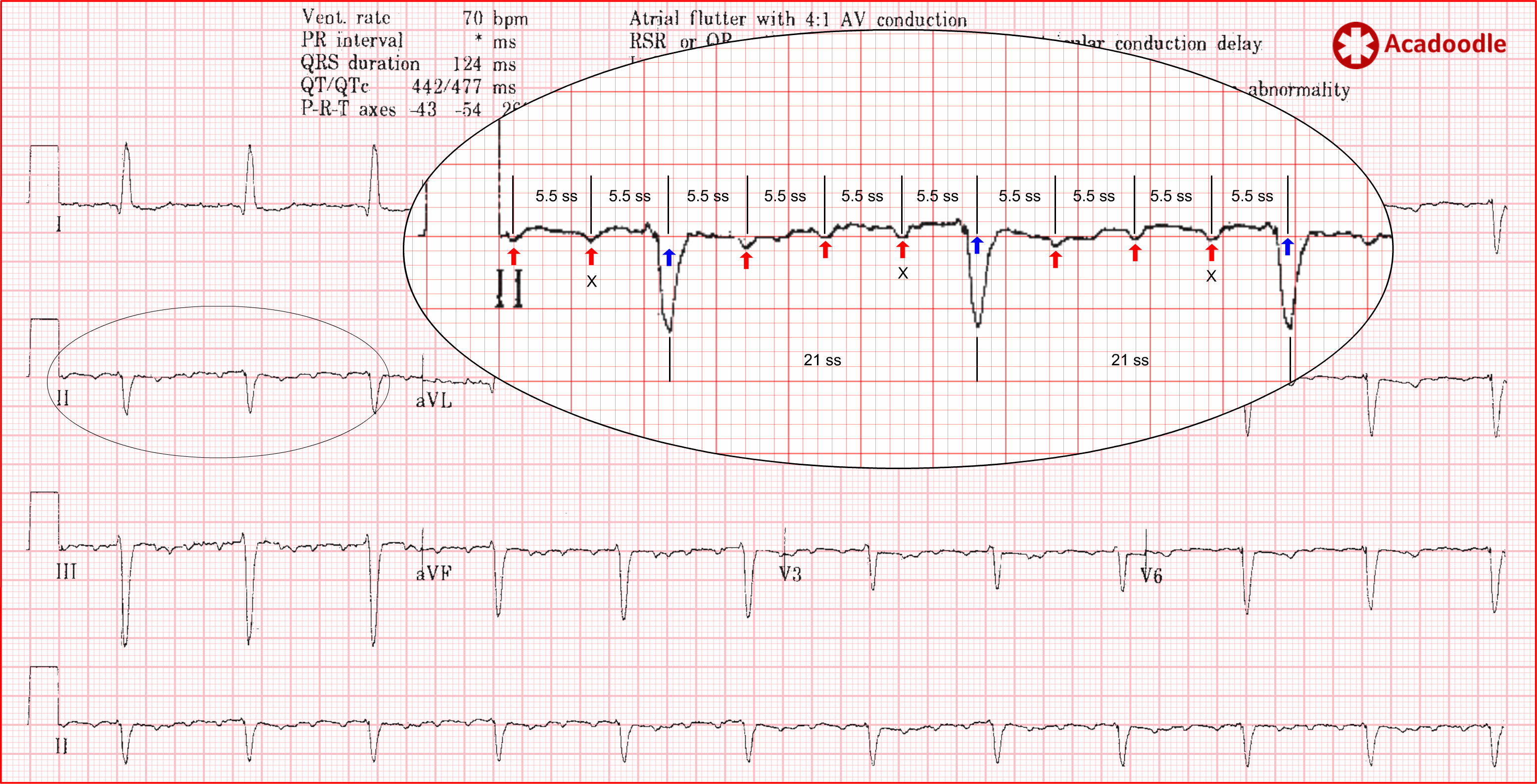 Atrial Flutter Sawtooth Ecg