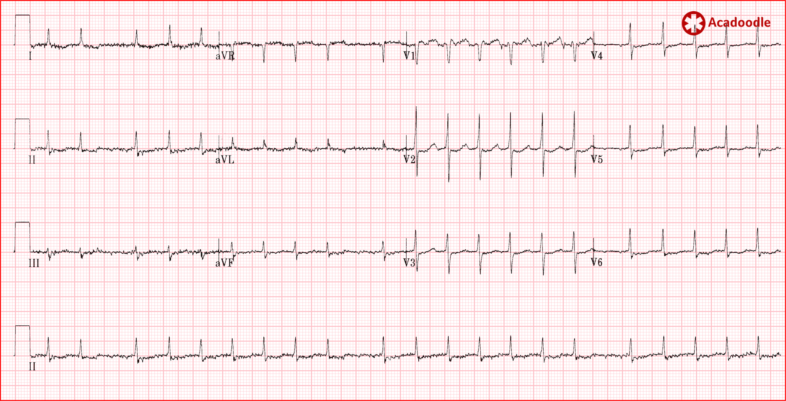 paroxysmal atrial tachycardia vs sinus tachycardia