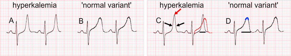 hyperkalemia ekg