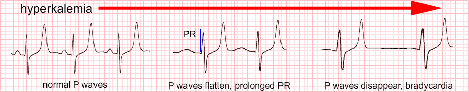 hyperkalemia ecg changes