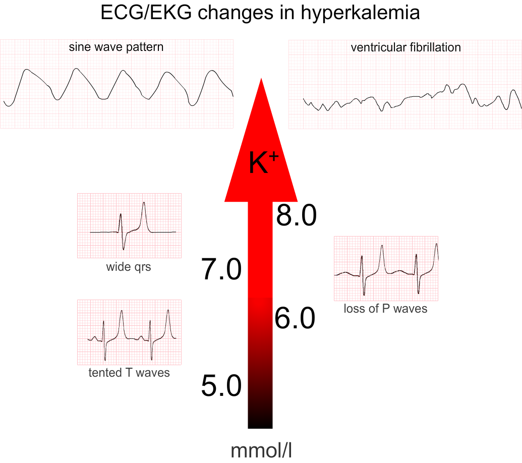 severe hyperkalemia ecg