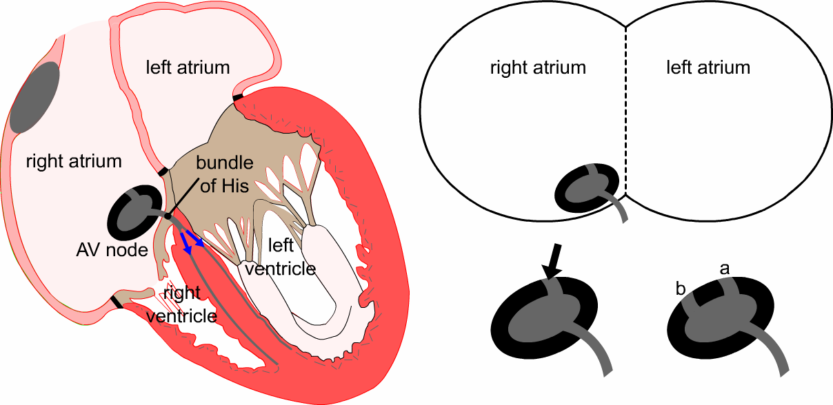 Tachycardia Diagram